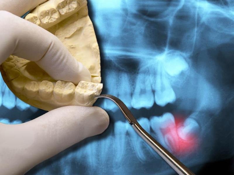 Dentes do Siso ou 3º molar: 4 fatos que você precisa saber
