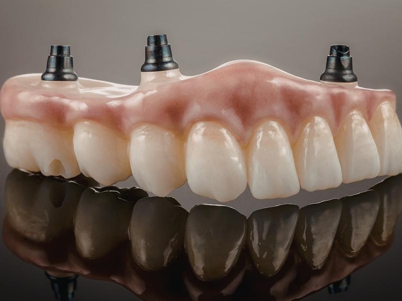 Quanto Tempo Dura uma Prótese Feita com CadCam?