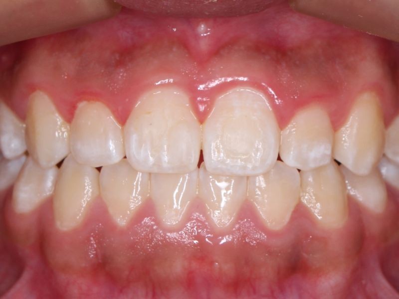 Alinhadores Ortodônticos