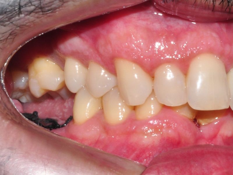 Alinhadores Ortodônticos