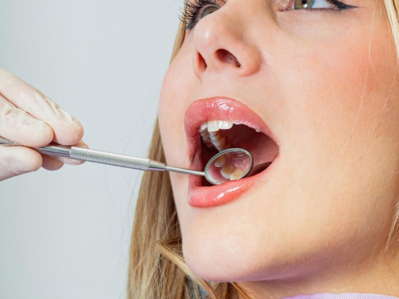 Tratamento para Tártaro no Dente