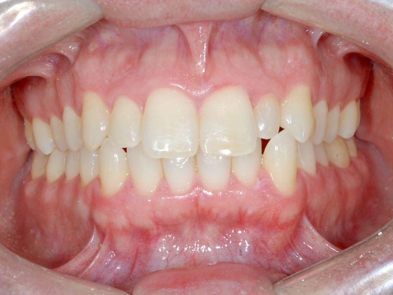 Alinhadores Ortodônticos