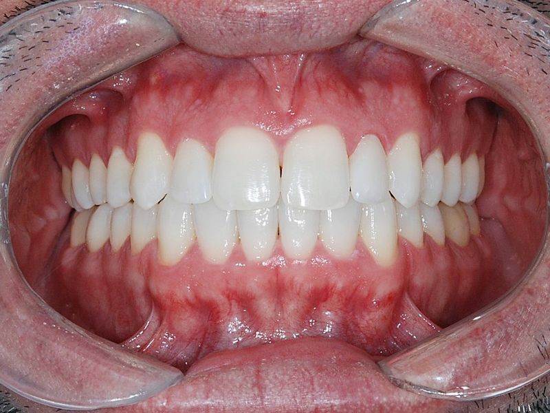 Alinhadores Ortodônticos