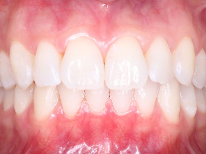 Alinhadores Ortodônticos