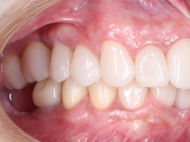 Alinhadores Ortodônticos