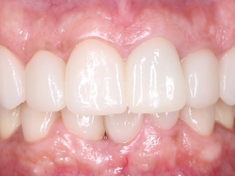 Alinhadores Ortodônticos