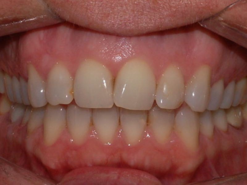 Alinhadores Ortodônticos