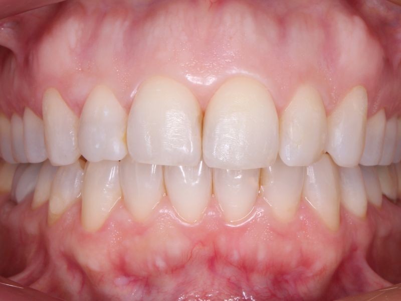 Alinhadores Ortodônticos