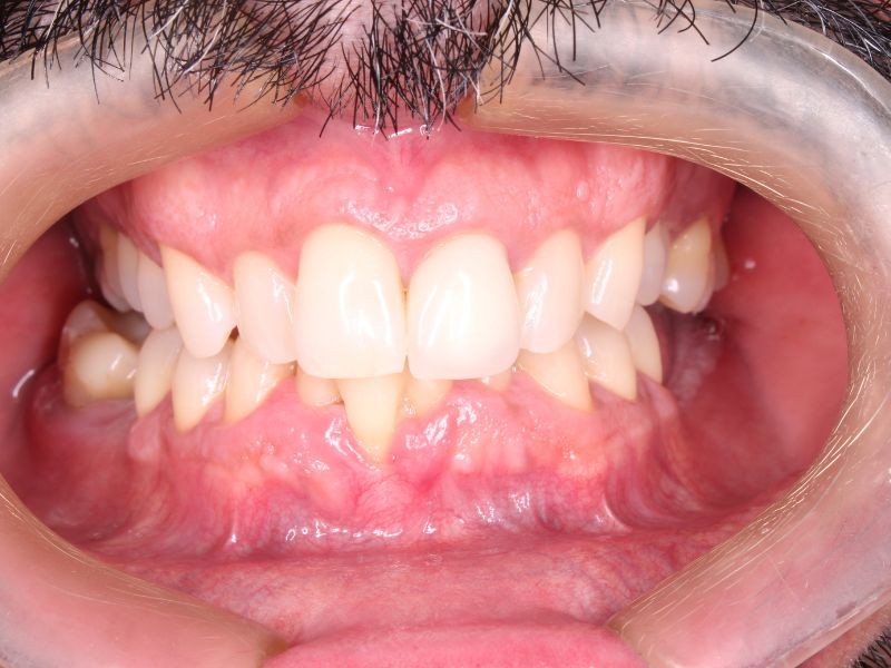 Alinhadores Ortodônticos