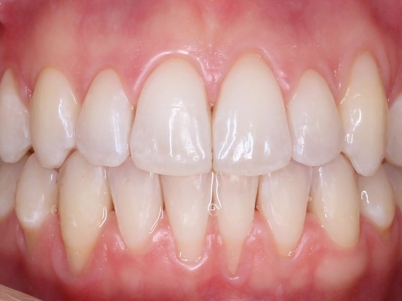 Alinhadores Ortodônticos