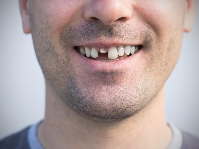 Tratamento para Dente Quebrado