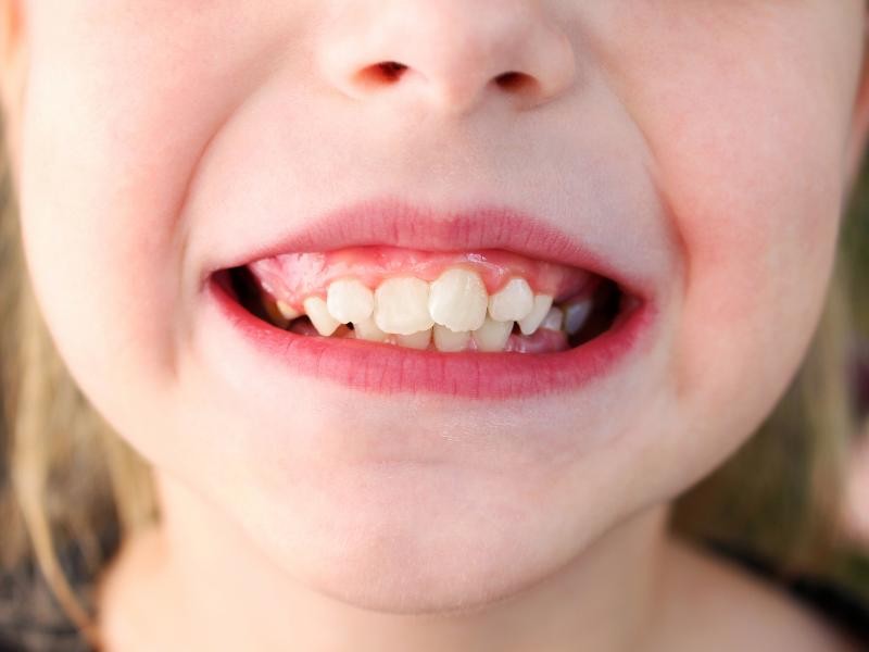 Tratamento para Dentes Tortos