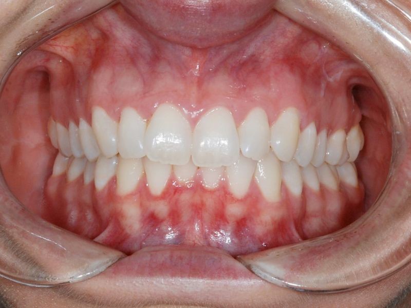 Alinhadores Ortodônticos