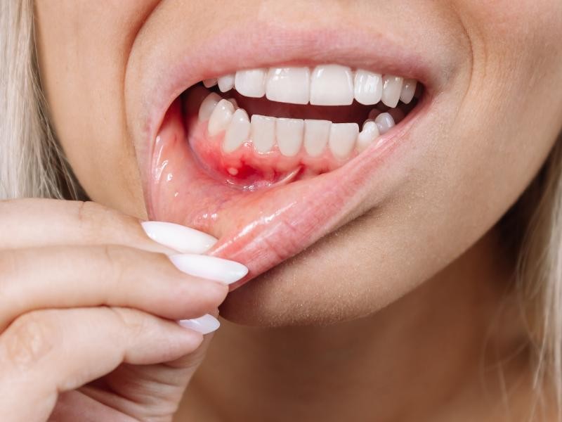 Tratamento para Sangramento na Gengiva