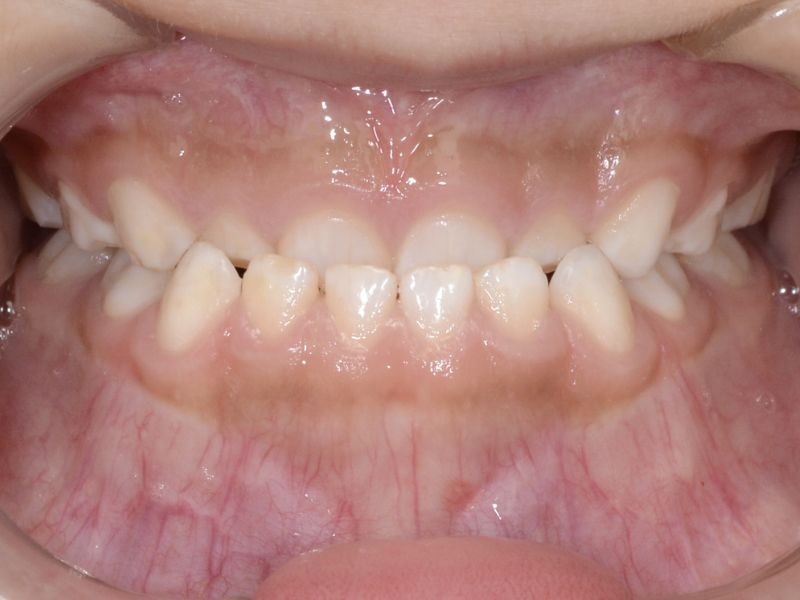 Alinhadores Ortodônticos