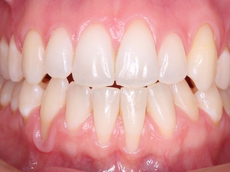 Alinhadores Ortodônticos